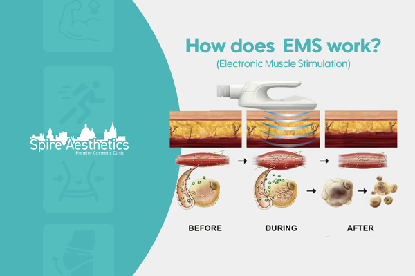 EMS treatment for post pregnancy weight loss treatment Wiltshire