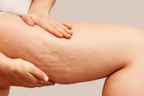 Image of woman showing leg with cellulite Wiltshire