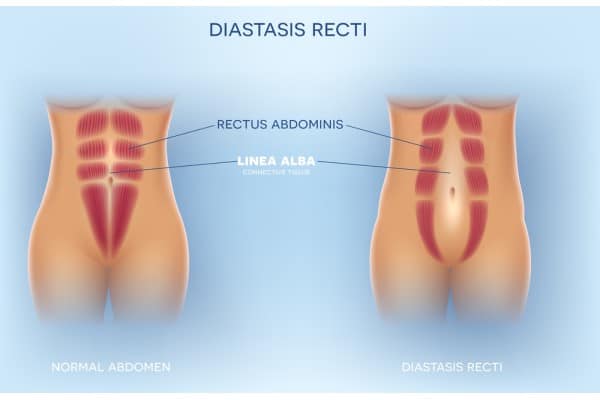 What Non-Surgical Options Are Available for Diastasis Recti Wiltshire?