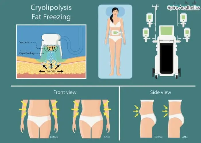 Fat freezing treatment Wiltshire benefits for competitions to remove stubborn fat deposits.