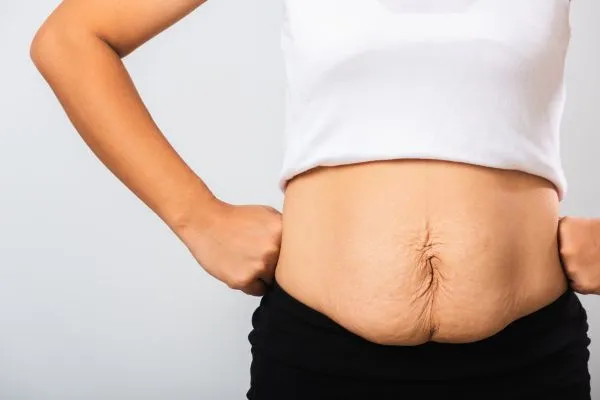 Image of a woman's stomach after weight loss with sagging skin following a gastric band Wiltshire