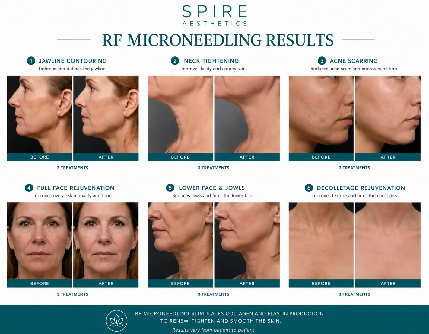 RF Microneedling Skin tightening Wiltshire results