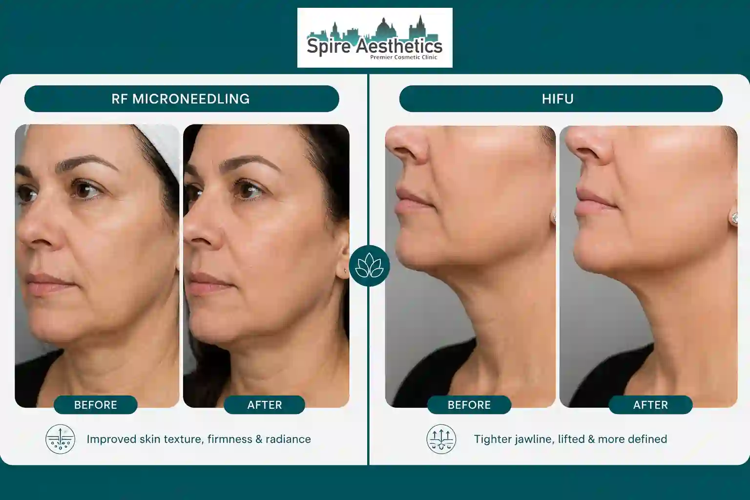 Can RF Microneedling and HIFU Be Combined Wiltshire?