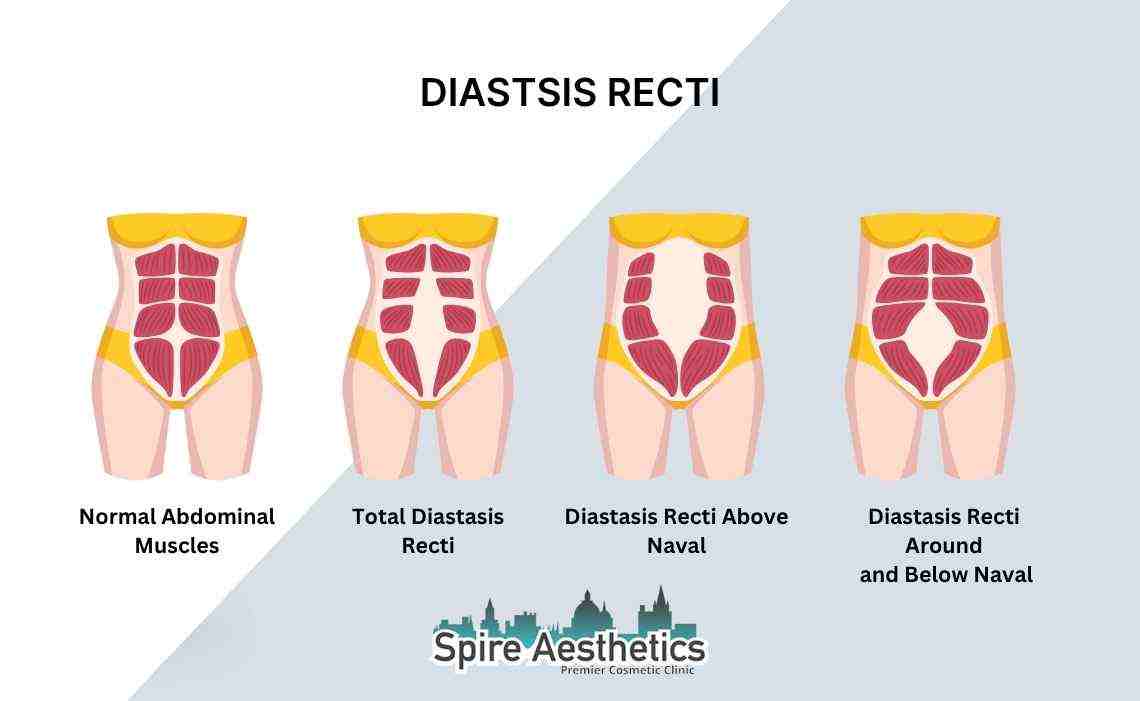 Is Non-Surgical Diastasis Recti Treatment Right for You? Common Concerns Answered Wiltshire
